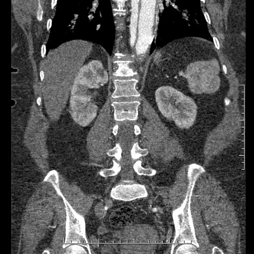 Aortic dissection- Stanford A (Radiopaedia 35729-37268 F 12).jpg