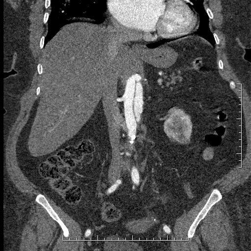 File:Aortic dissection- Stanford A (Radiopaedia 35729-37268 F 32).jpg