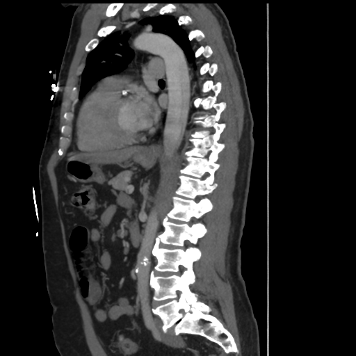 File:Aortic dissection- Stanford A (Radiopaedia 37759-39664 Sagittal C+ delayed 23).png