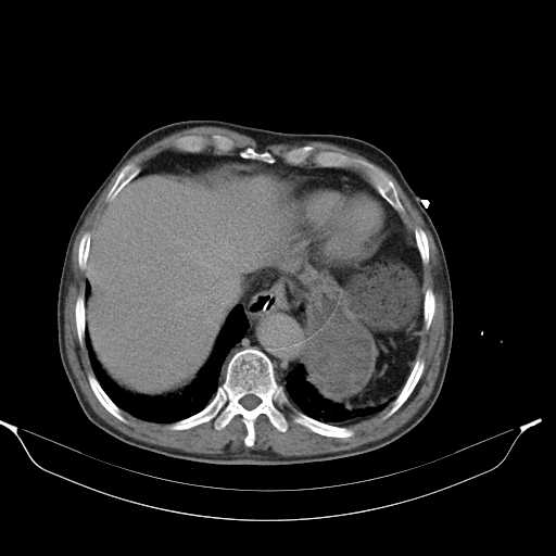 File:Aortic dissection- Stanford type A (Radiopaedia 22085-22085 Axial C+ delayed 7).jpg