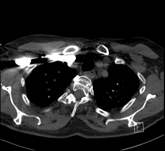 File:Aortic dissection (CTPA) (Radiopaedia 75506-86751 Axial C+ CTPA 24).jpg