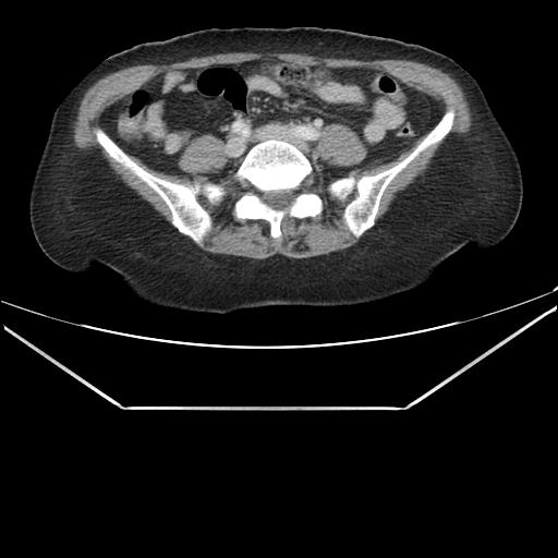 Aortic dissection (Radiopaedia 25350-25604 C 77).jpg