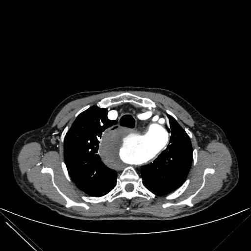 Aortic dissection (Radiopaedia 27466-27665 C+ arterial phase 27).jpg