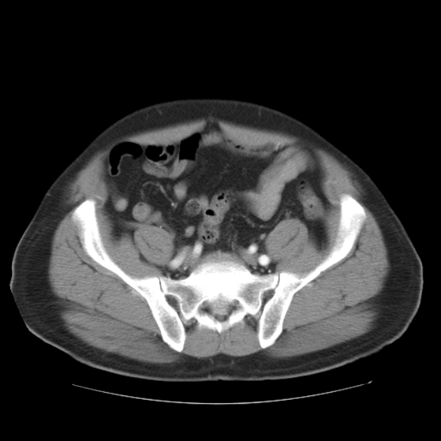Aortic dissection (Radiopaedia 44411-48061 C 47).jpg