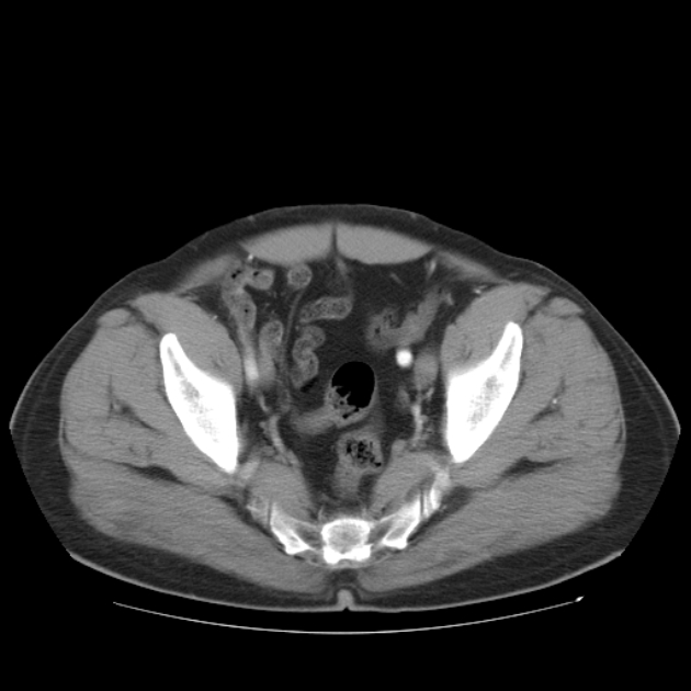 Aortic dissection (Radiopaedia 44411-48061 C 52).jpg