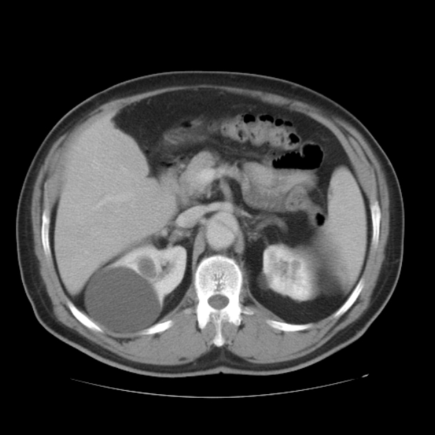 Aortic dissection (Radiopaedia 44411-48061 C 76).jpg