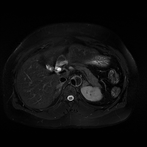 File:Aortic dissection (Radiopaedia 57969-64956 Axial T2 fat sat 24).jpg