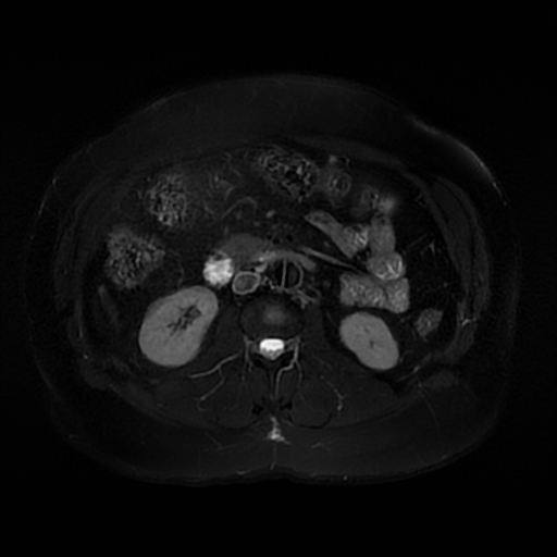 File:Aortic dissection (Radiopaedia 57969-64956 Axial T2 fat sat 35).jpg