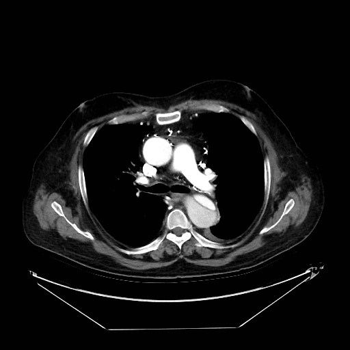Aortic dissection (Radiopaedia 62562-71000 A 14).jpg