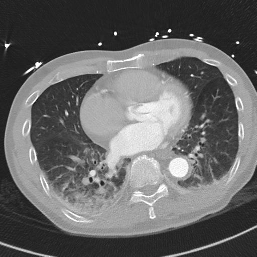 Aortic dissection - DeBakey type II (Radiopaedia 64302-73082 Axial lung window 41).png
