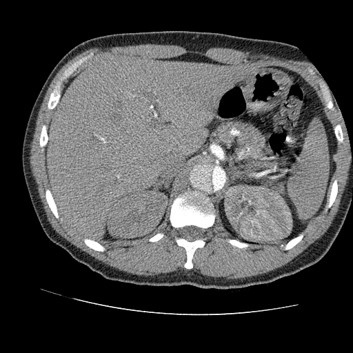 File:Aortic dissection - Stanford A -DeBakey I (Radiopaedia 28339-28587 B 108).jpg