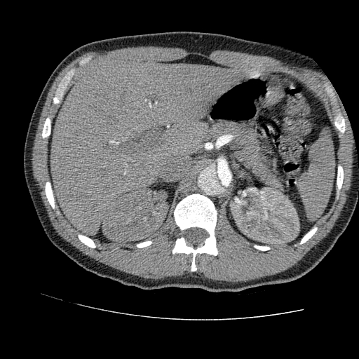 File:Aortic dissection - Stanford A -DeBakey I (Radiopaedia 28339-28587 B 113).jpg