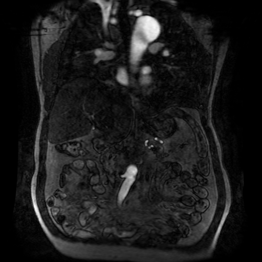 File:Aortic dissection - Stanford A - DeBakey I (Radiopaedia 23469-23551 D 112).jpg