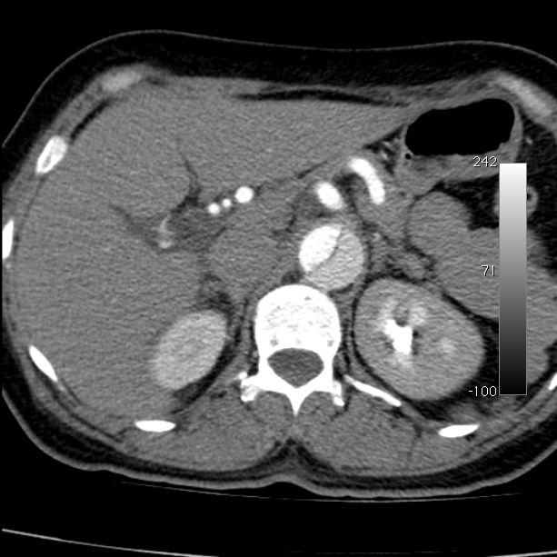 Aortic dissection - Stanford type A (Radiopaedia 29247-29659 A 81).jpg