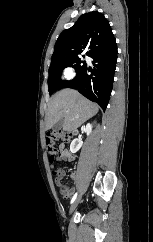 Aortic dissection - Stanford type A (Radiopaedia 83418-98500 B 3).jpg