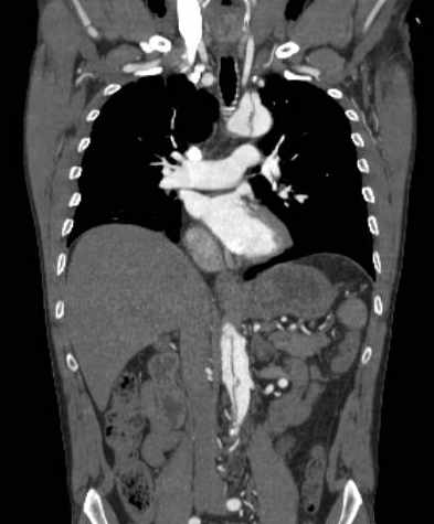 File:Aortic dissection - Stanford type B (Radiopaedia 73648-84437 B 59).jpg