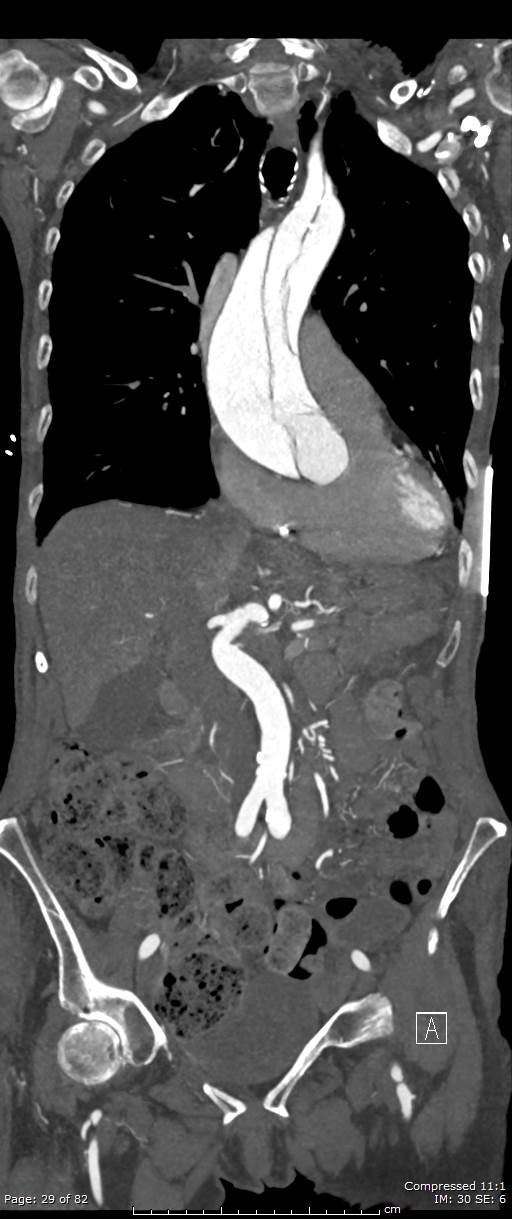 Aortic dissection with extension into aortic arch branches (Radiopaedia 64402-73204 A 29).jpg