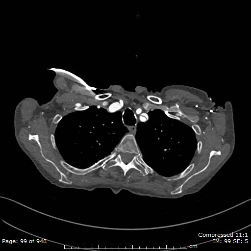 File:Aortic dissection with extension into aortic arch branches (Radiopaedia 64402-73204 B 99).jpg