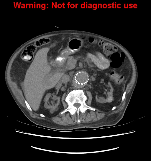 File:Aortic graft infection (Radiopaedia 44979-48907 Axial non-contrast 41).jpg
