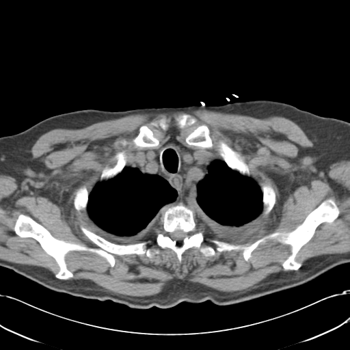 File:Aortic intramural hematoma (Radiopaedia 34260-35540 Axial non-contrast 9).png