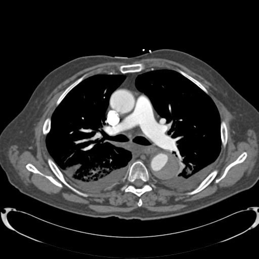 Aortic intramural hematoma (Radiopaedia 34260-35540 B 17).png