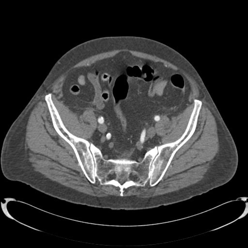 Aortic intramural hematoma (Radiopaedia 34260-35540 B 79).png