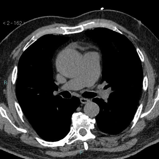 File:Aortic intramural hematoma (Radiopaedia 48463-53380 Axial non-contrast 72).jpg