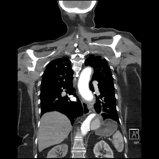 Aortic intramural hematoma with dissection and intramural blood pool (Radiopaedia 77373-89491 C 43).jpg