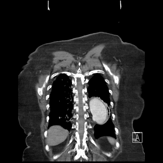File:Aortic intramural hematoma with dissection and intramural blood pool (Radiopaedia 77373-89491 C 57).jpg