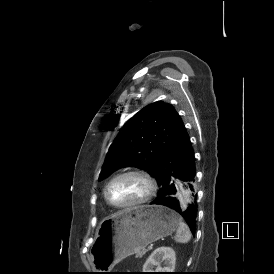 Aortic intramural hematoma with dissection and intramural blood pool (Radiopaedia 77373-89491 D 69).jpg