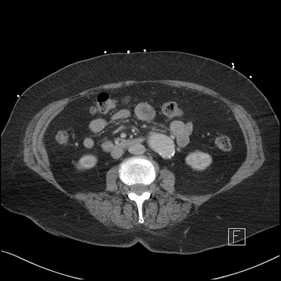 File:Aortic intramural hematoma with dissection and intramural blood pool (Radiopaedia 77373-89491 E 40).jpg
