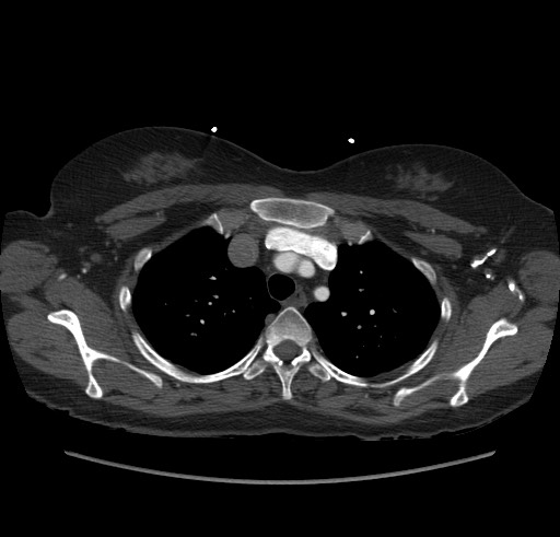 Aortic nipple (Radiopaedia 63008-71449 B 22).jpg