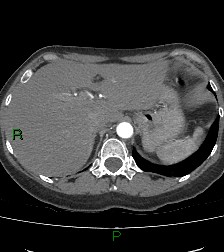 Aortic valve endocarditis (Radiopaedia 87209-103485 C 91).jpg
