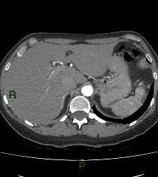 Aortic valve endocarditis (Radiopaedia 87209-103485 C 93).jpg