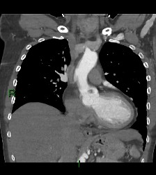 Aortic valve endocarditis (Radiopaedia 87209-103485 D 41).jpg