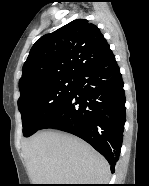 Aortic valve non-coronary cusp thrombus (Radiopaedia 55661-62189 D 38).png