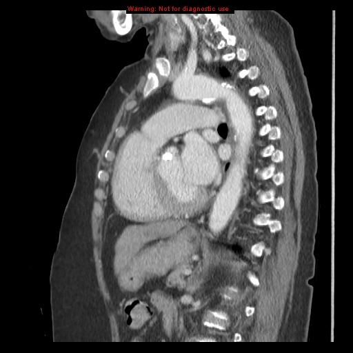 File:Aortic valve stenosis (Radiopaedia 14480-14423 B 7).jpg