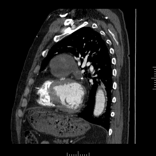 File:Aorto-coronary bypass graft aneurysms (Radiopaedia 40562-43157 C 29).png