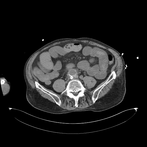 Aortoduodenal fistula (Radiopaedia 75286-86415 Axial non-contrast 45).jpg