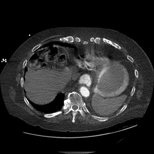 Aortoesophageal fistula with endovascular repair (Radiopaedia 73781-84592 Axial C+ CTPA 138).jpg