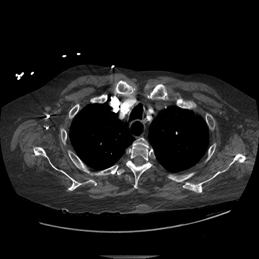 File:Aortoesophageal fistula with endovascular repair (Radiopaedia 73781-84592 Axial C+ CTPA 16).jpg