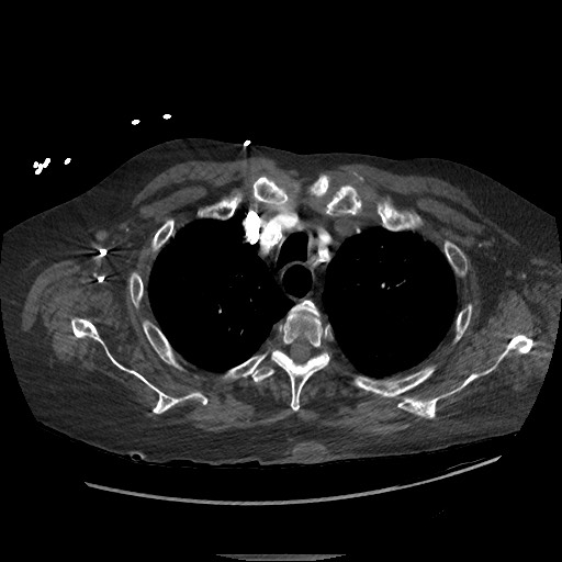 Aortoesophageal fistula with endovascular repair (Radiopaedia 73781-84592 Axial C+ CTPA 18).jpg