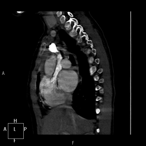 File:Aortopulmonary septal defect (Radiopaedia 41990-45013 Sagittal C+ CTPA 35).jpg