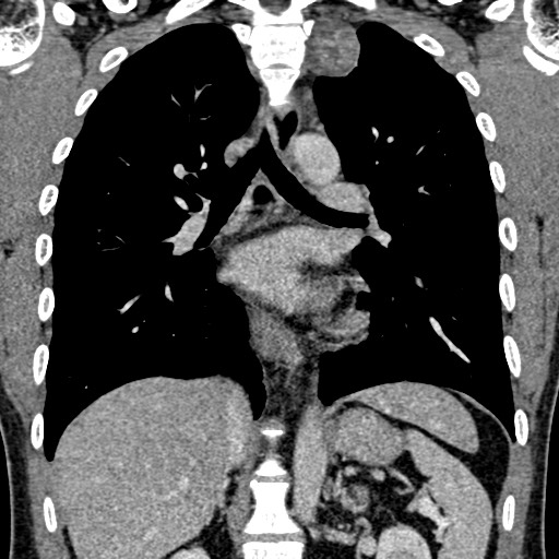 File:Apical lung mass mimic - neurogenic tumor (Radiopaedia 59918-67521 B 68).jpg