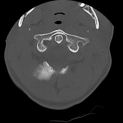 Apical pneumothorax on cervical spine CT (Radiopaedia 45343-49368 Axial bone window 12).jpg