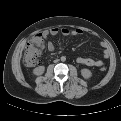 Appendicitis and giant appendicolith (Radiopaedia 80251-93588 Axial non-contrast 29).jpg