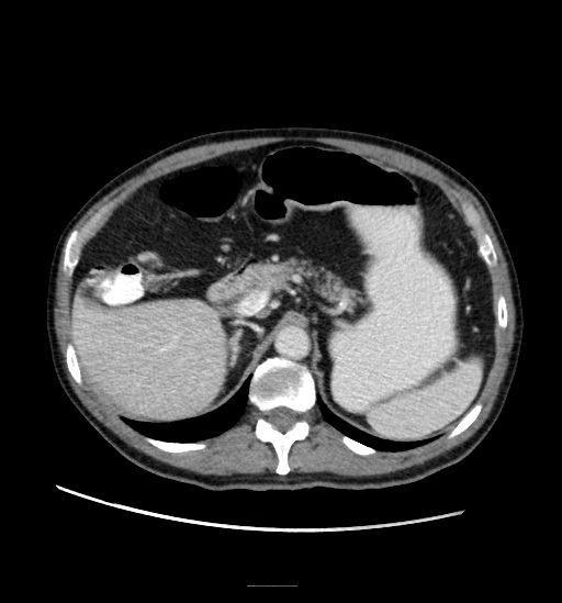 Appendicitis with localized perforation and abscess formation (Radiopaedia 49035-54130 A 28).jpg