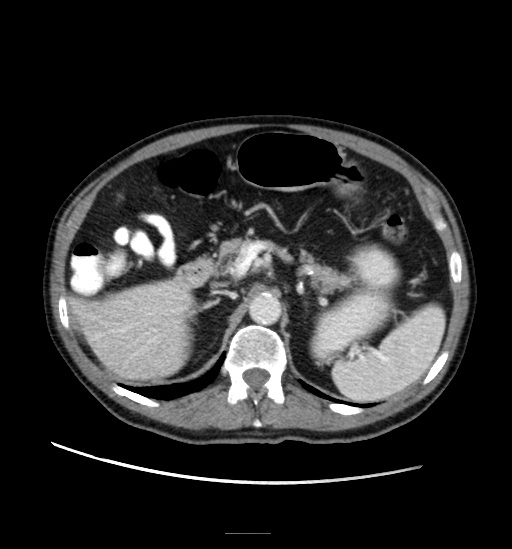 File:Appendicitis with localized perforation and abscess formation (Radiopaedia 49035-54130 A 30).jpg