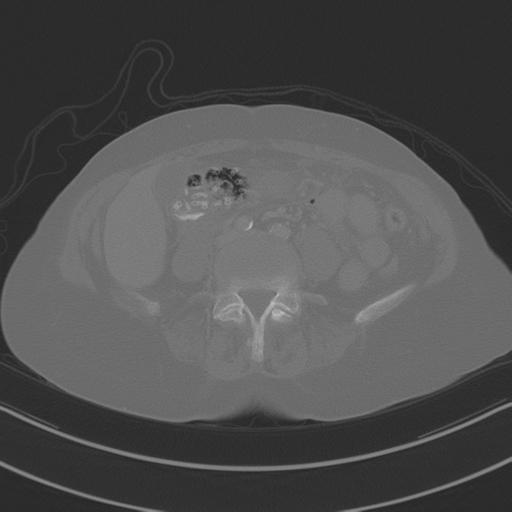 April fools' 2019- calcified peritoneal arachnoidosis (Radiopaedia 67273-76636 Axial bone window 27).png