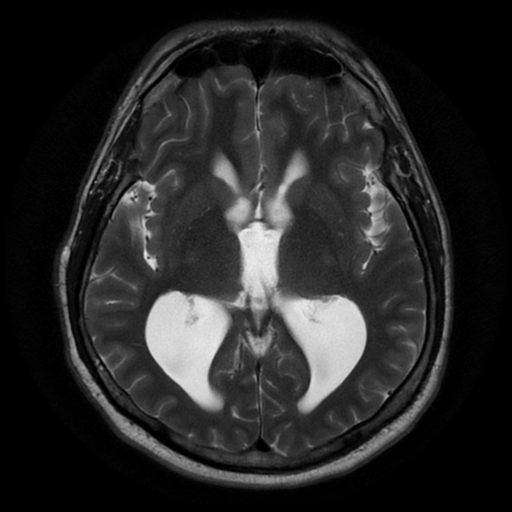 File:Aqueduct stenosis with corpus callosum hypoattenuation post shunting (Radiopaedia 37212-38969 Axial T2 10).png